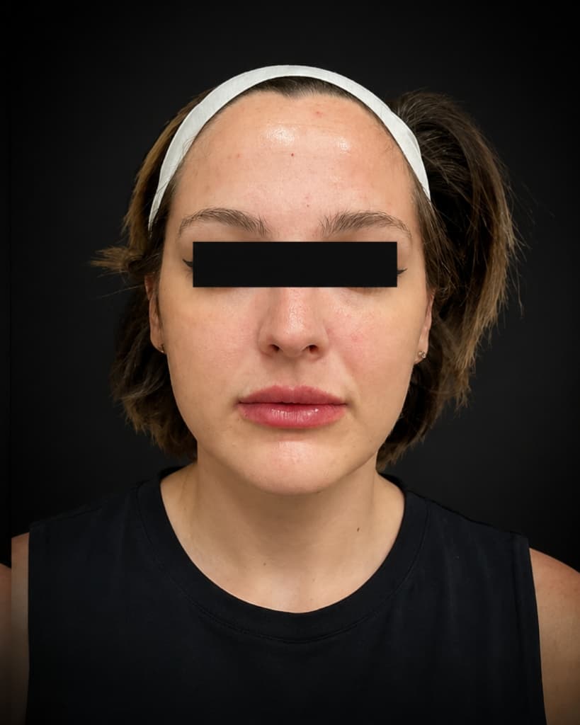 Lip Fillers After