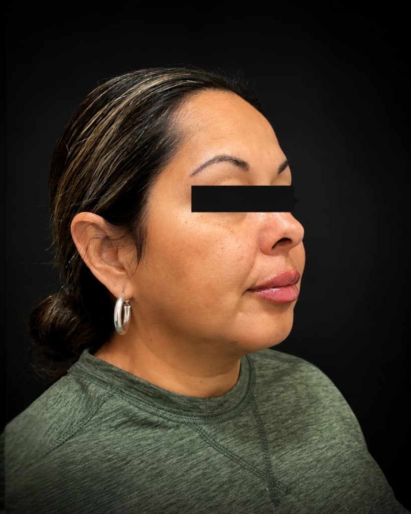 Lip Fillers After