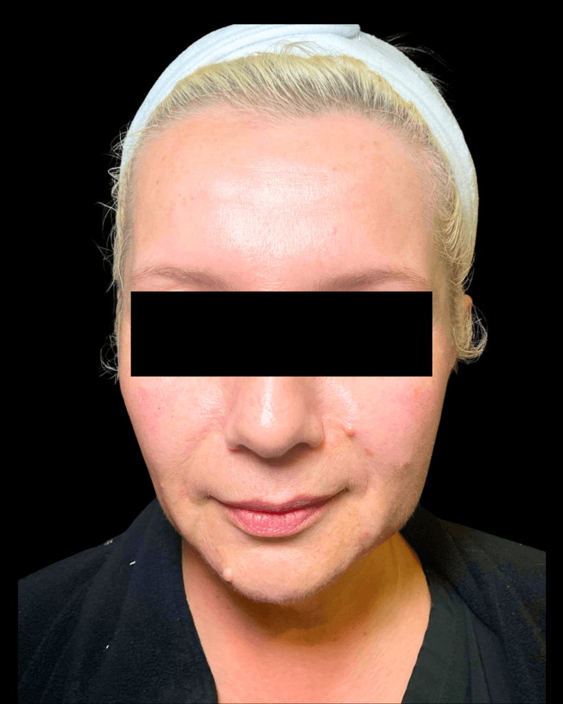 Lip Fillers After