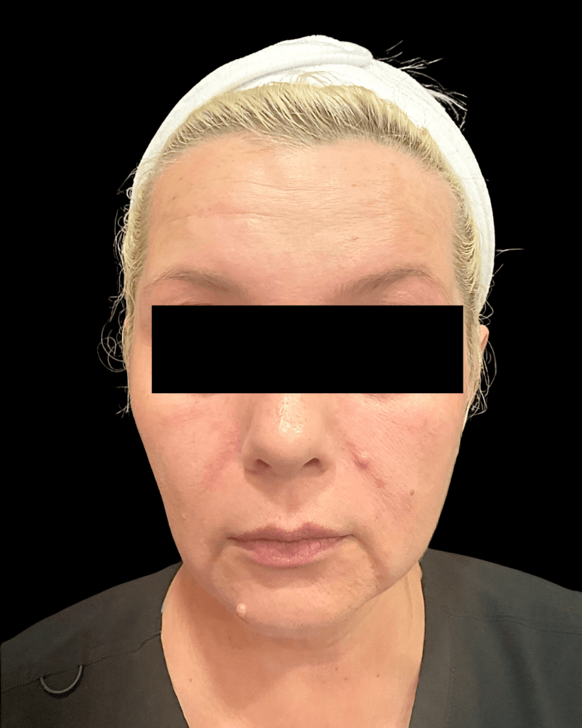 Lip Fillers Before