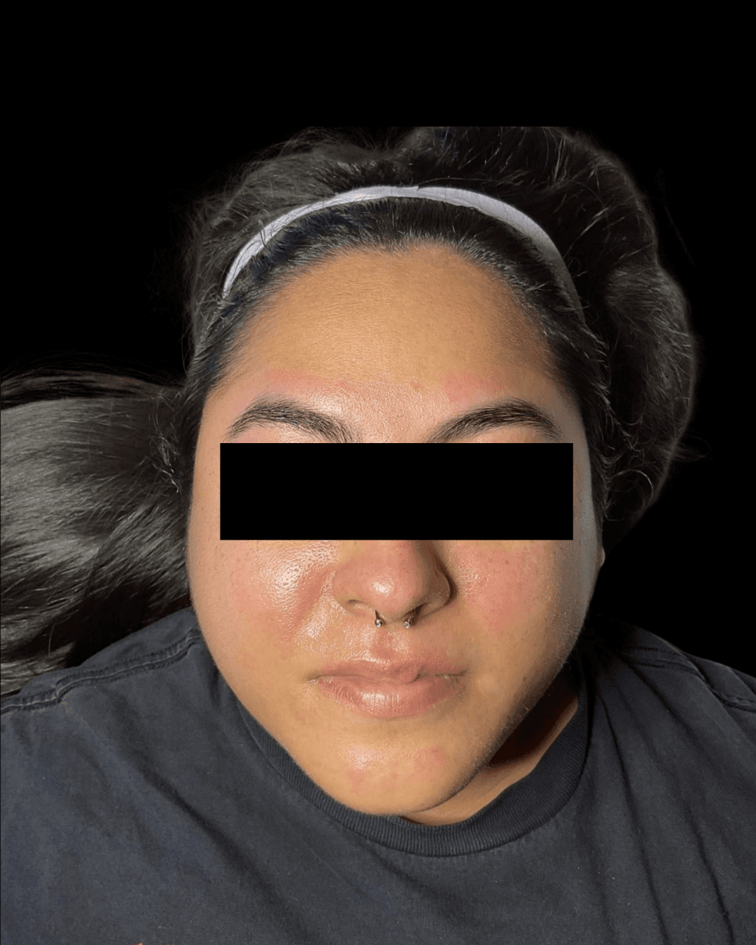 HydraFacial After