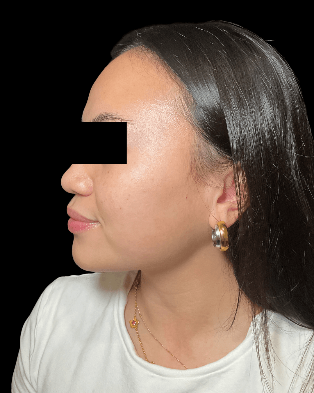 SkinPen (Microneedling) Before