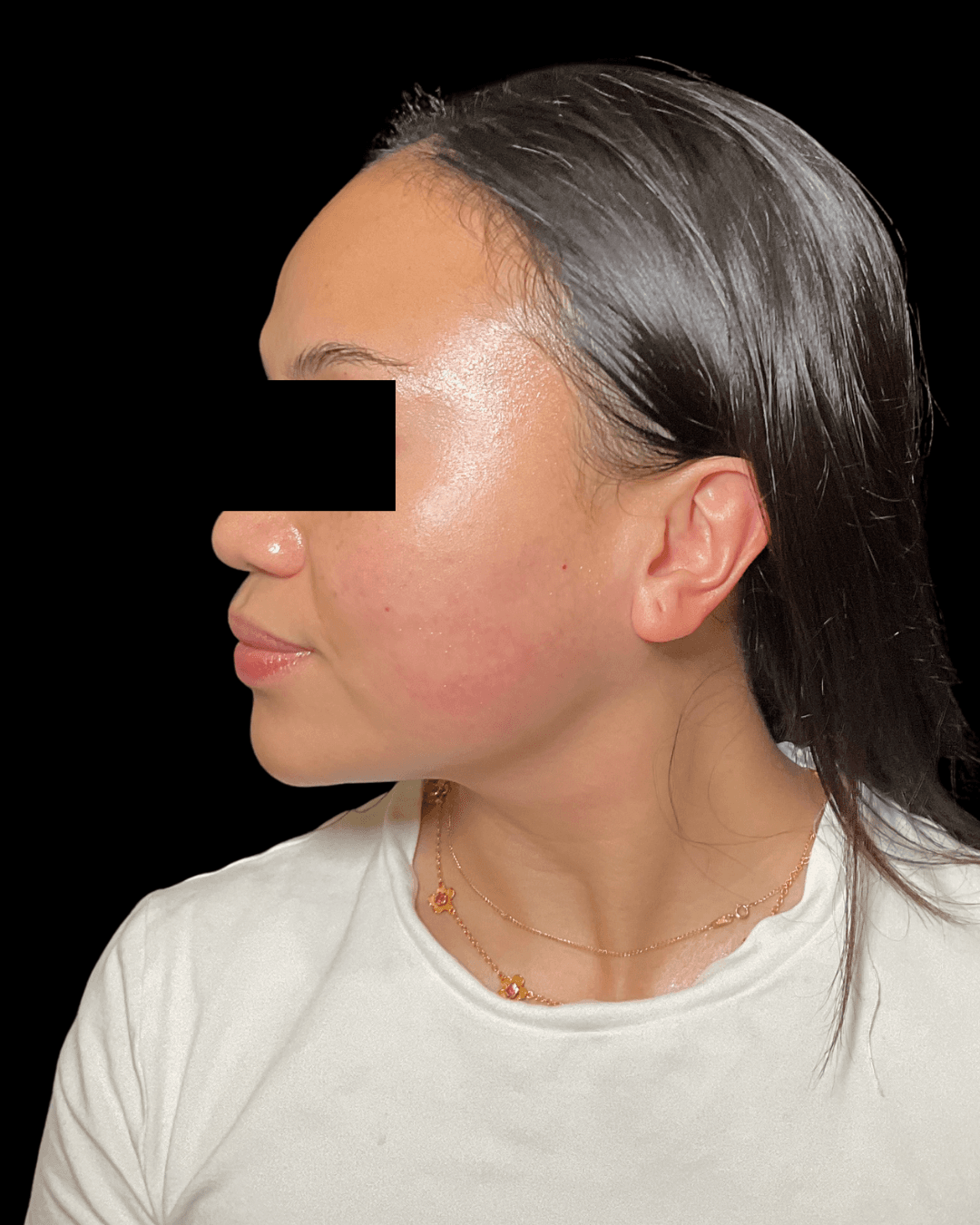 SkinPen (Microneedling) After