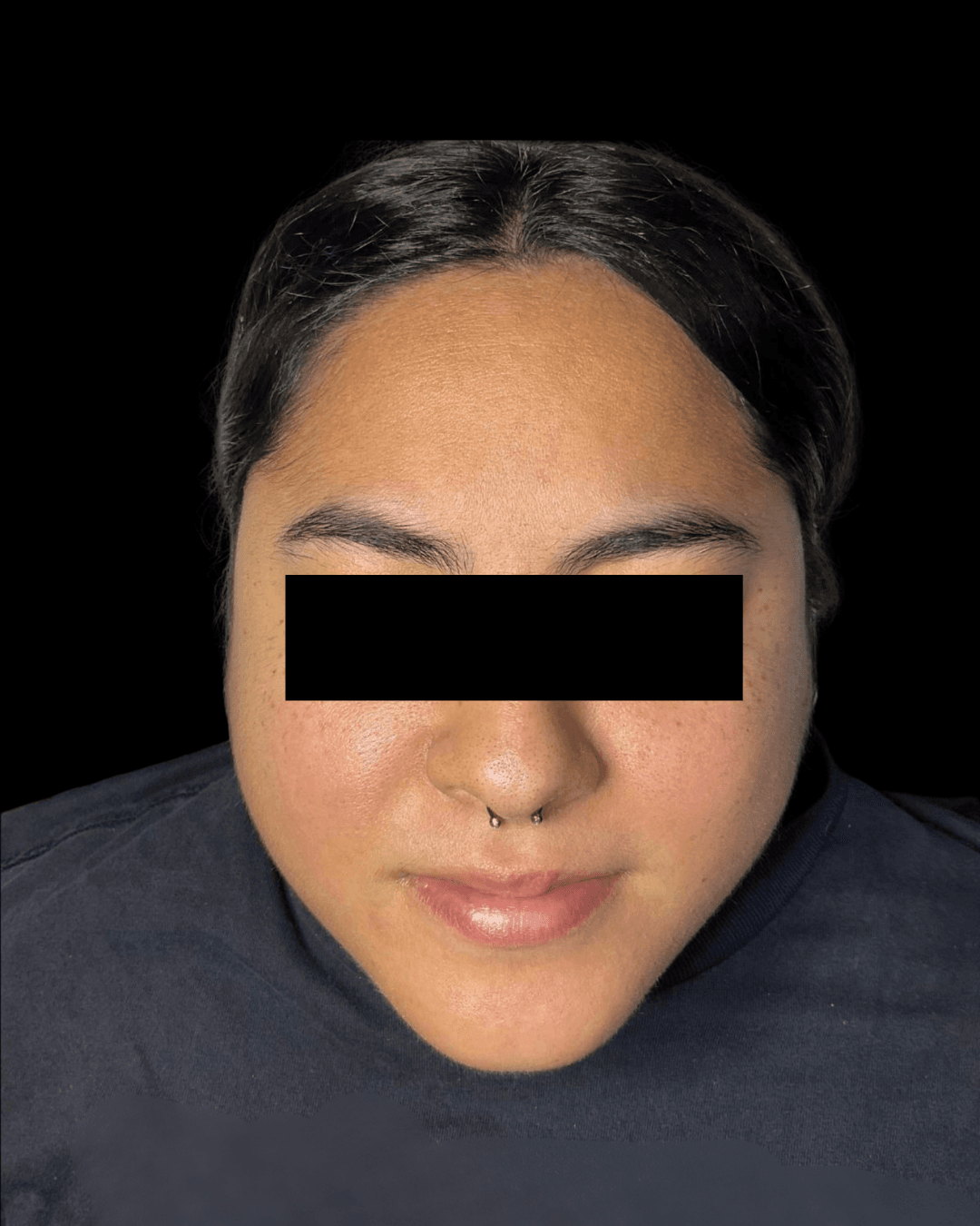 HydraFacial Before
