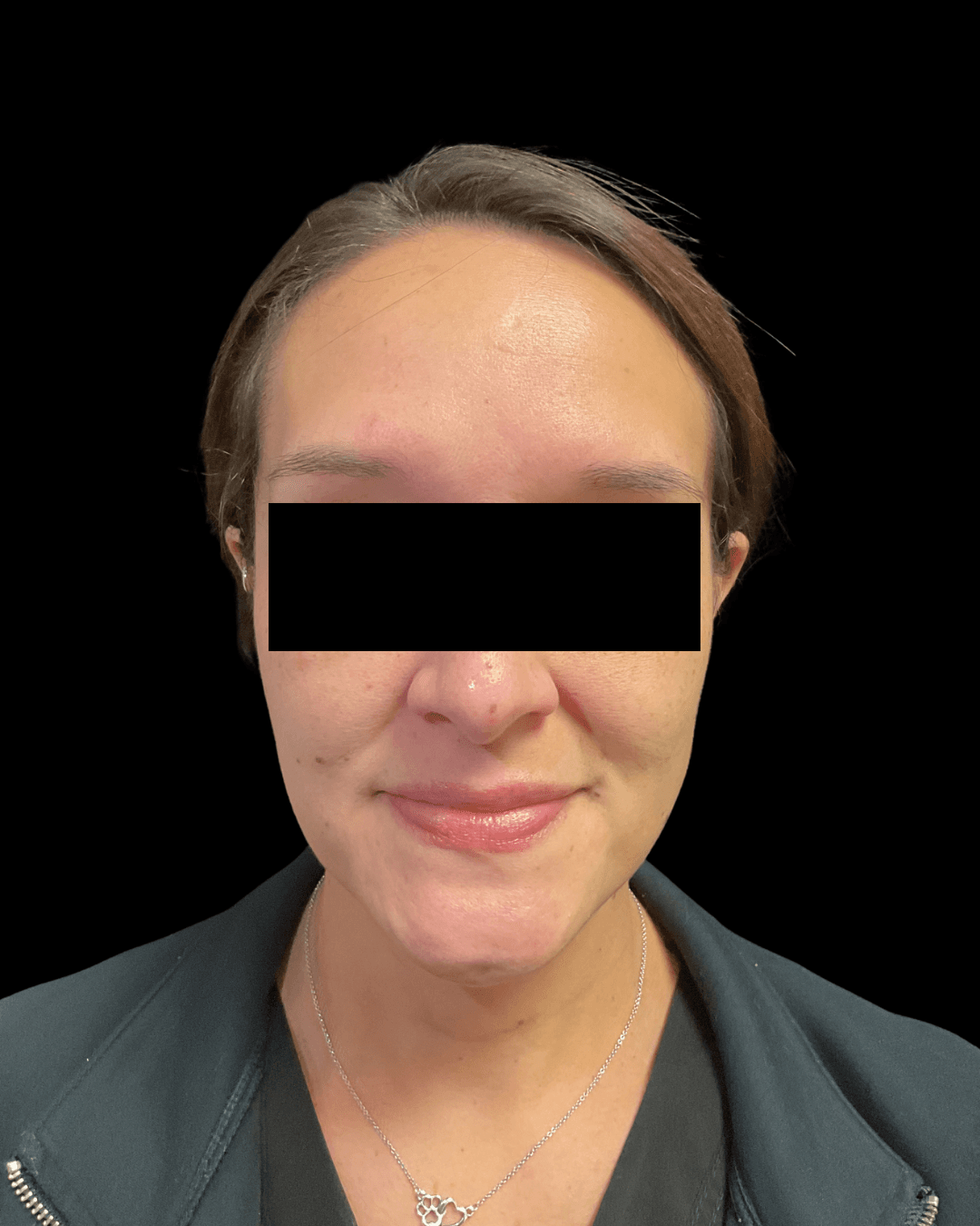 HydraFacial Before