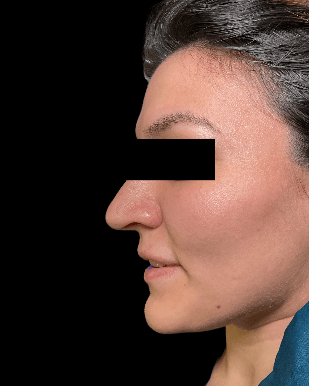 Jan Marini Enzyme Facial Before
