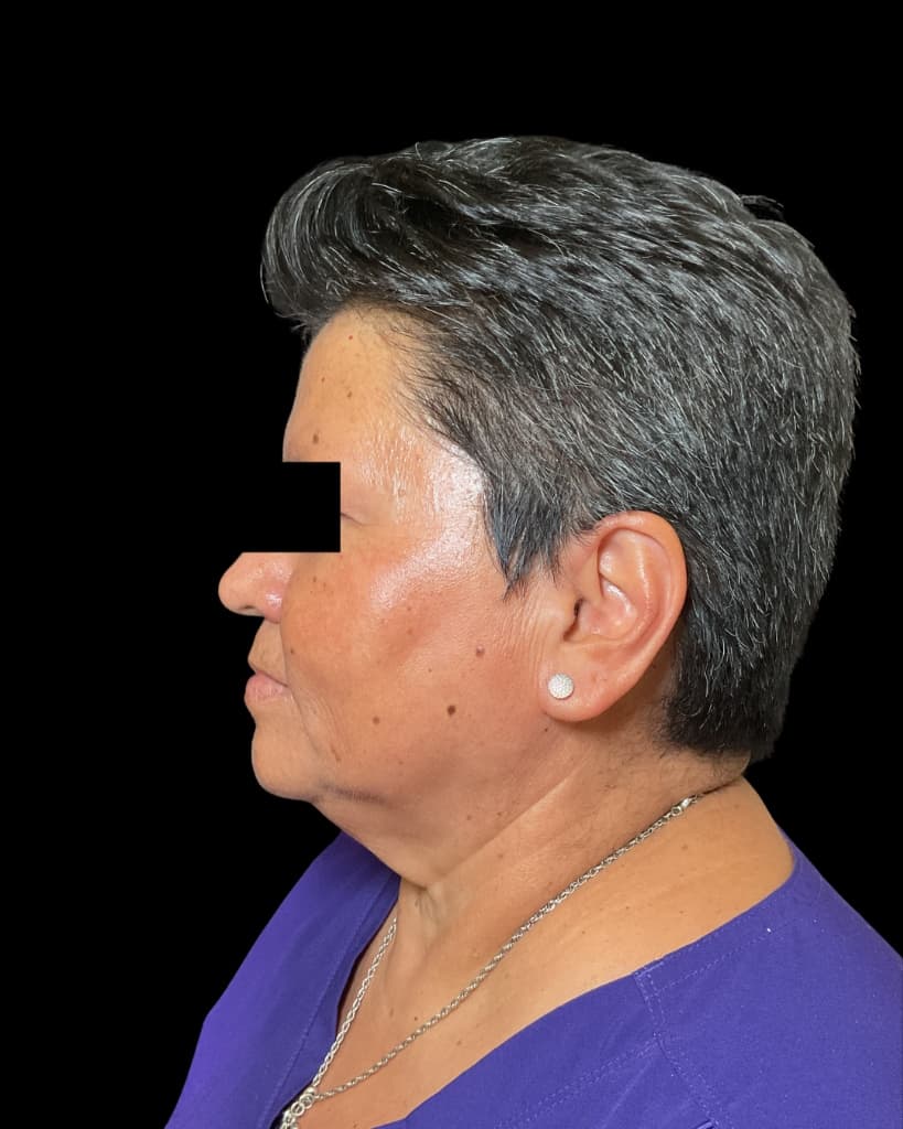 SkinPen (Microneedling) After