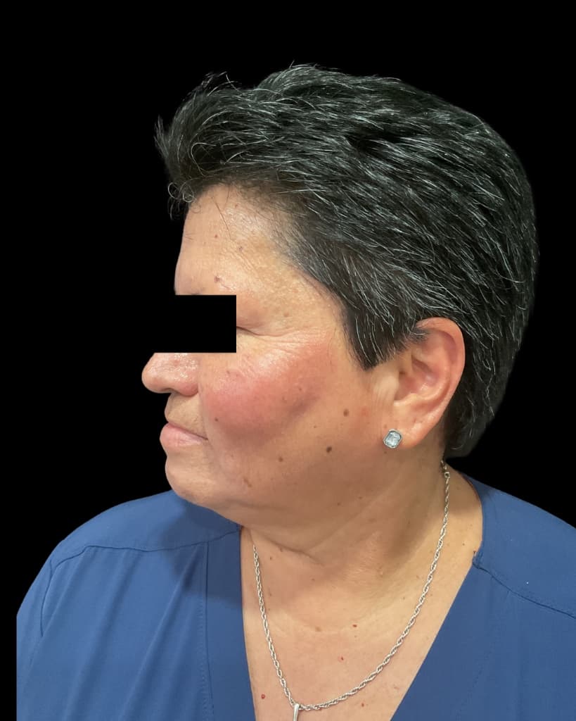 SkinPen (Microneedling) Before