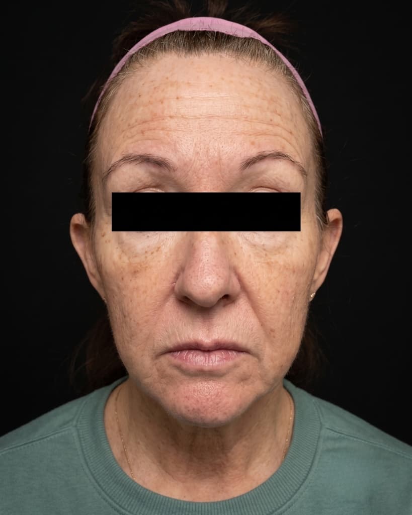 Neurotoxins Before