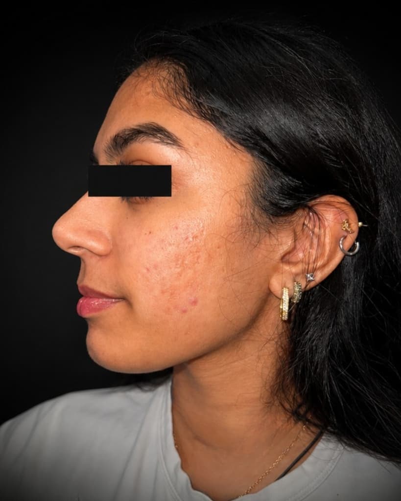 Chemical Peels Before