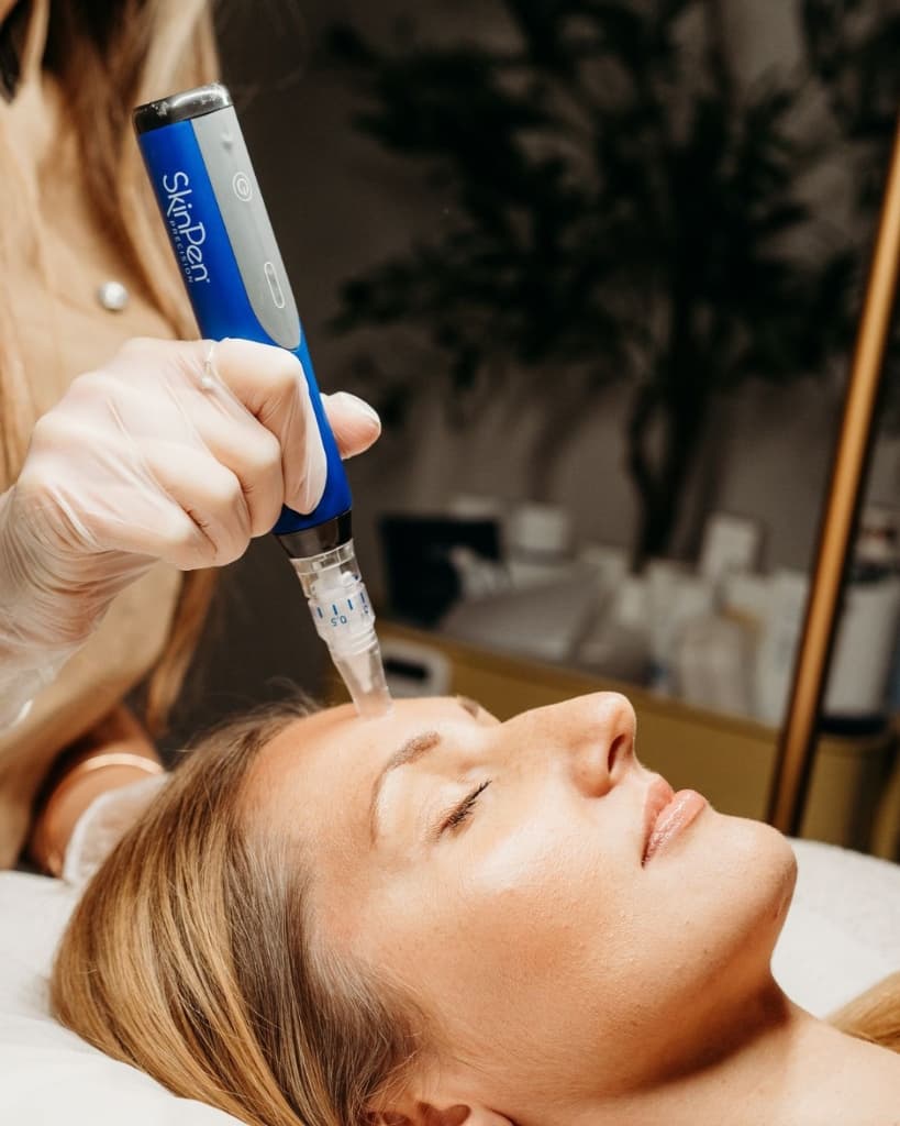 SkinPen (Microneedling)